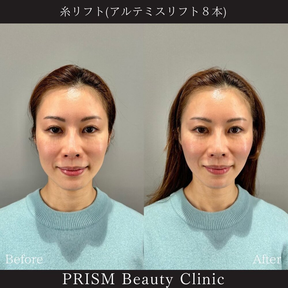 アルテミスリフト