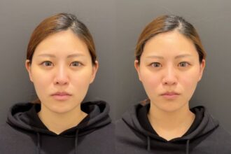 アルテミスリフト アルテミスリフト