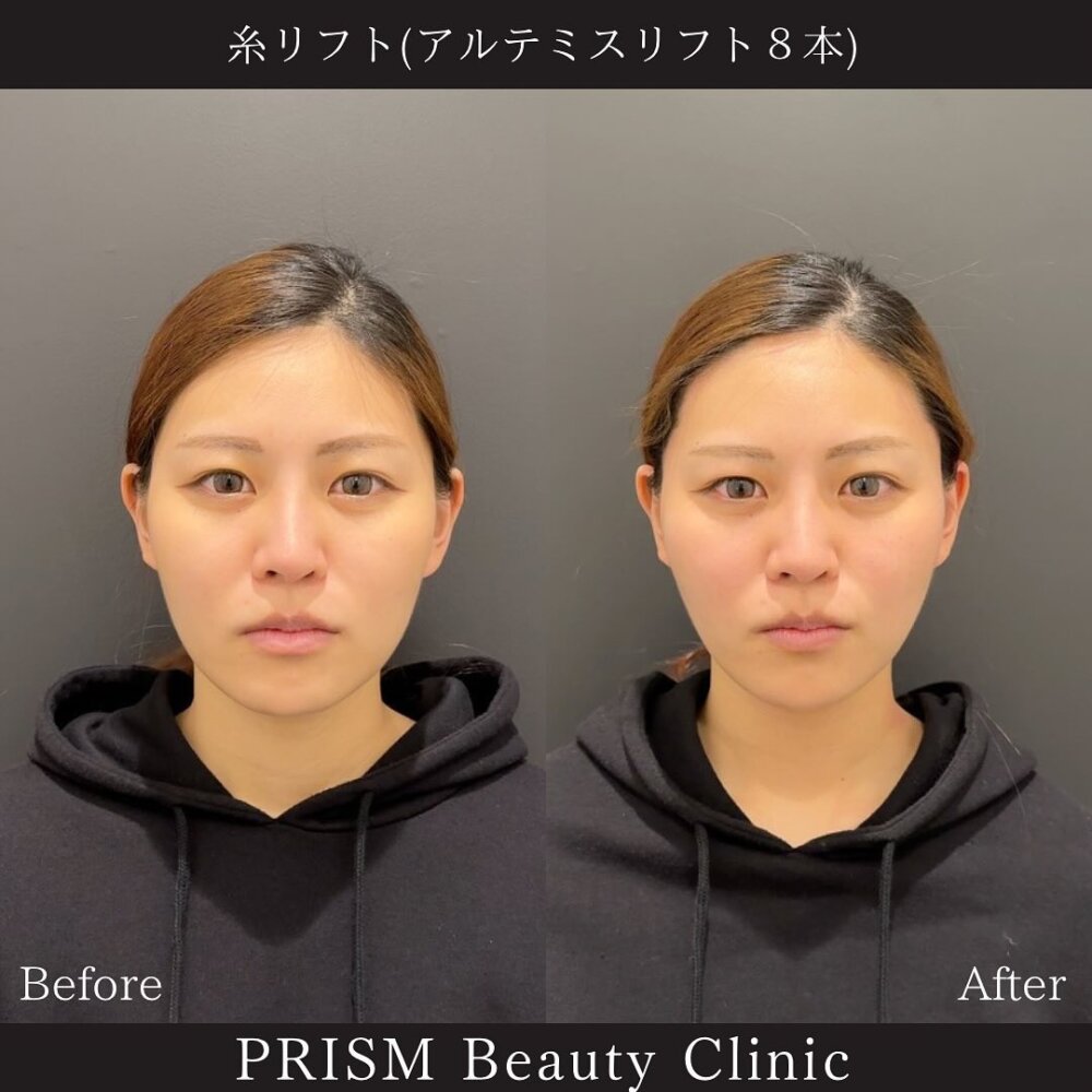 アルテミスリフト