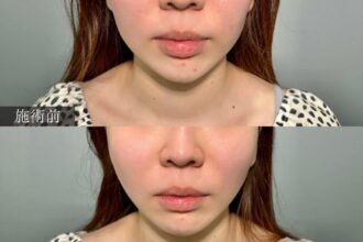 アルテミスリフト アルテミスリフト