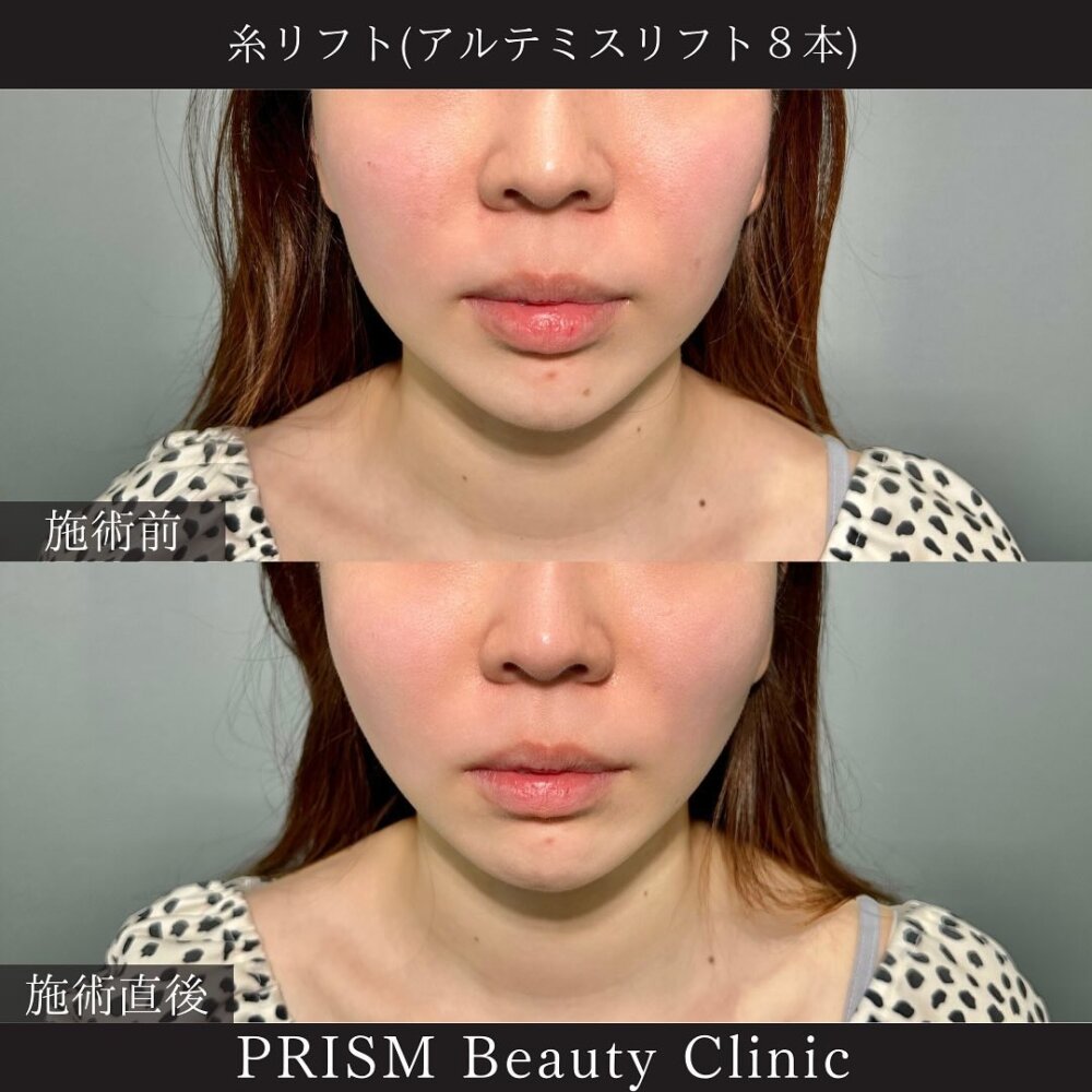 アルテミスリフト