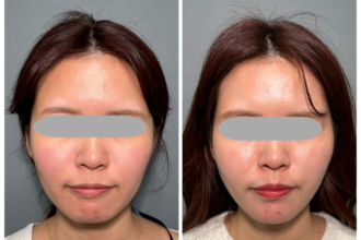 PRISMリフト・ヒアルロン酸注射（あご）