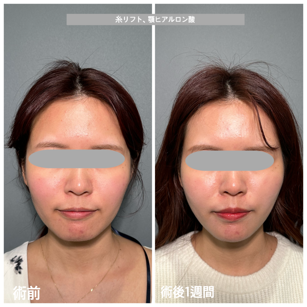 PRISMリフト・ヒアルロン酸注射（あご）