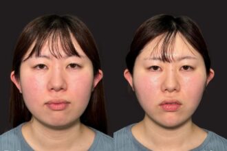 PRISM小顔リフト・あご先リフト PRISM小顔リフト・あご先リフト