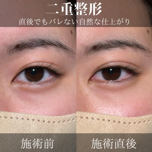 【中古】 夢をかなえる美容整形 二重埋没 - 新宿・町田の美容外科・美容皮膚科｜PRISM Beauty Clinic