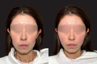 糸リフト(PRISMリフト・アルテミスリフト) 糸リフト(PRISMリフト・アルテミスリフト)