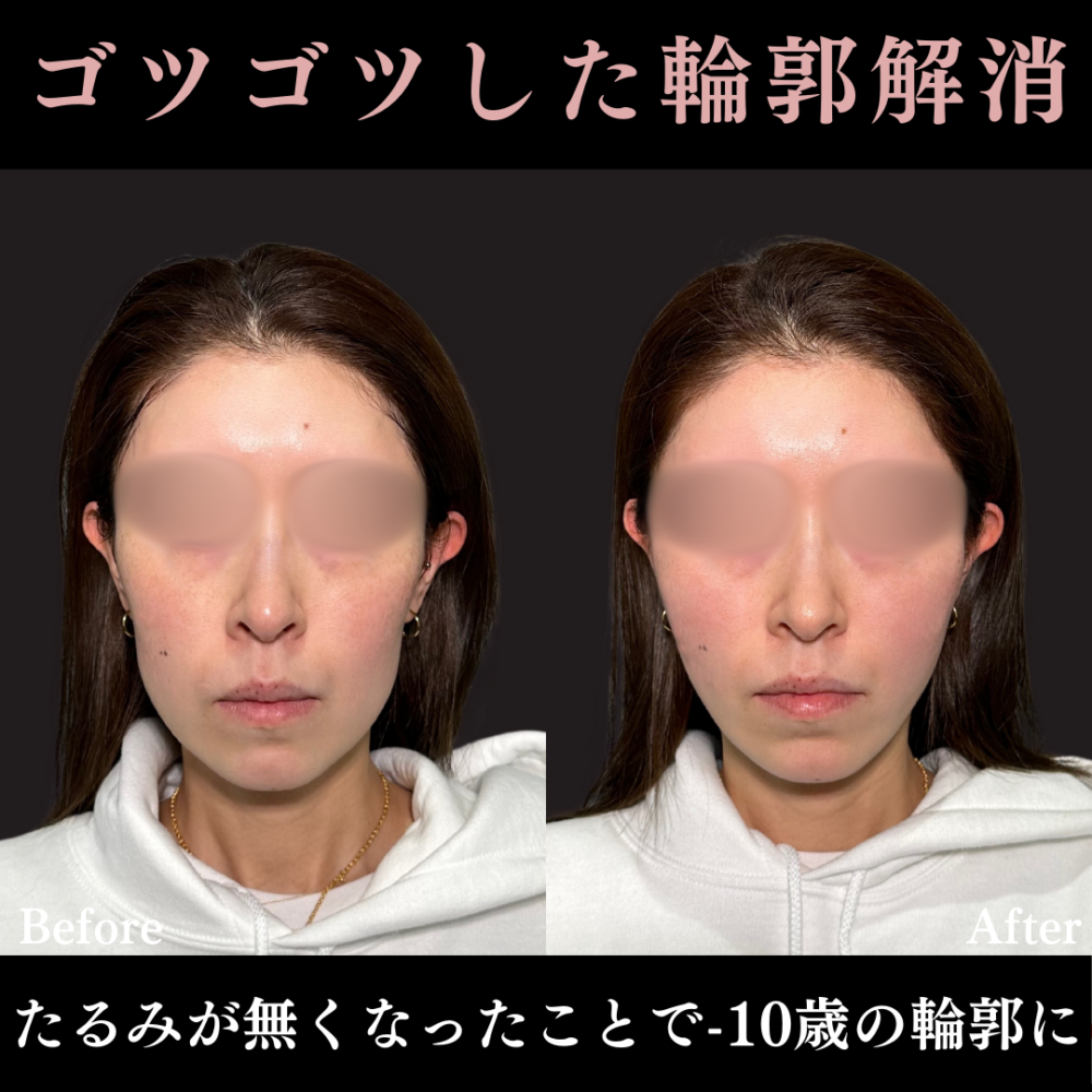 糸リフト（PRISMリフト・アルテミスリフト）