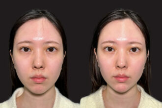 ヒアルロン酸注射（あご）