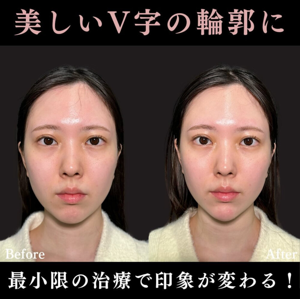 ヒアルロン酸注射（あご）