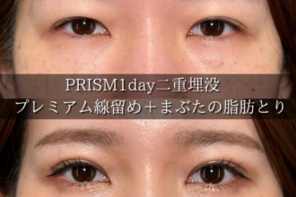PRISM 1day二重埋没+まぶたの脂肪取り(自然癒着法) PRISM 1day二重埋没+まぶたの脂肪取り(自然癒着法)