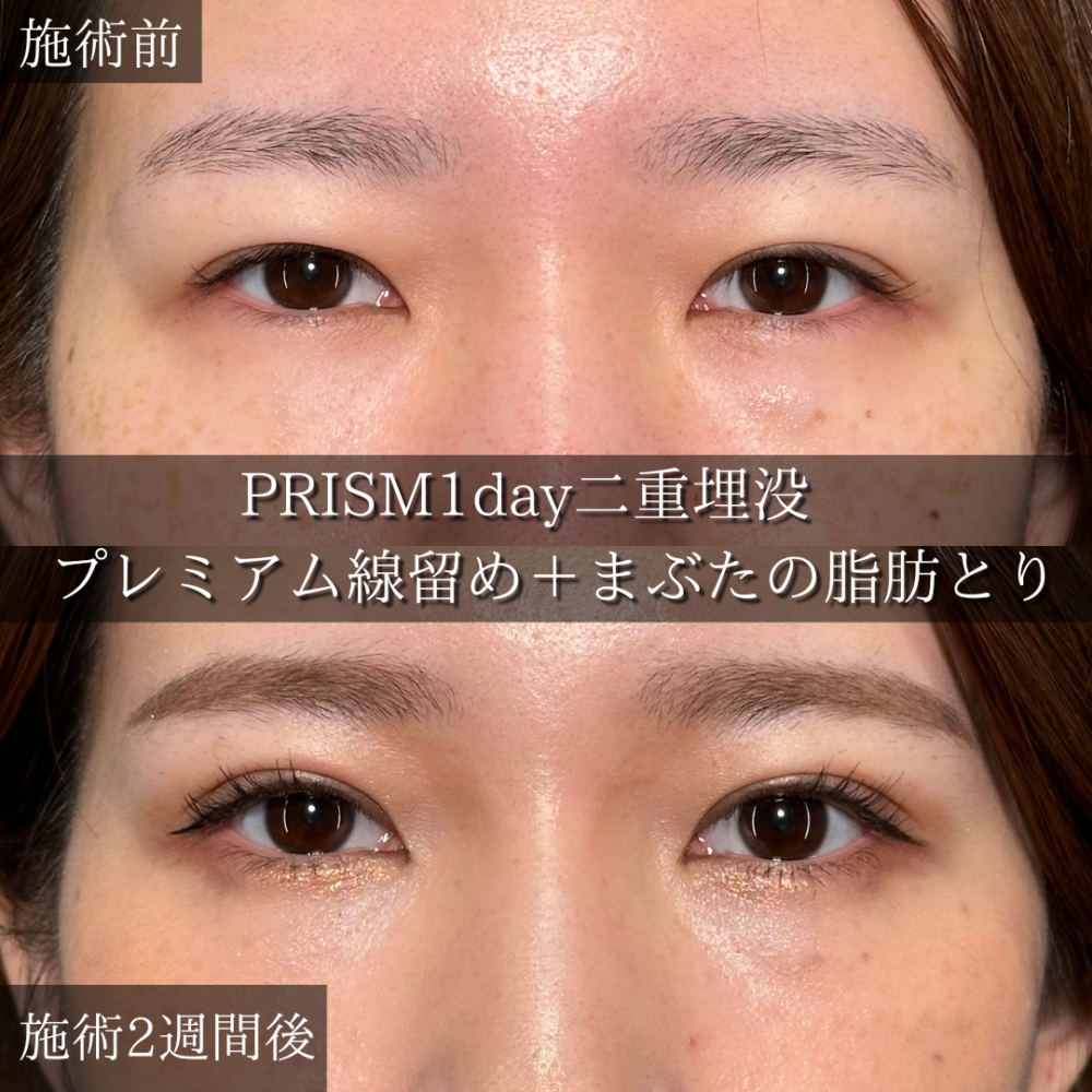 PRISM 1day二重埋没＋まぶたの脂肪取り（自然癒着法）