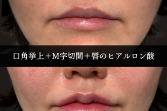 口角挙上＋M字リップ＋唇のヒアルロン酸注射