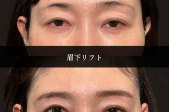 眉下リフト