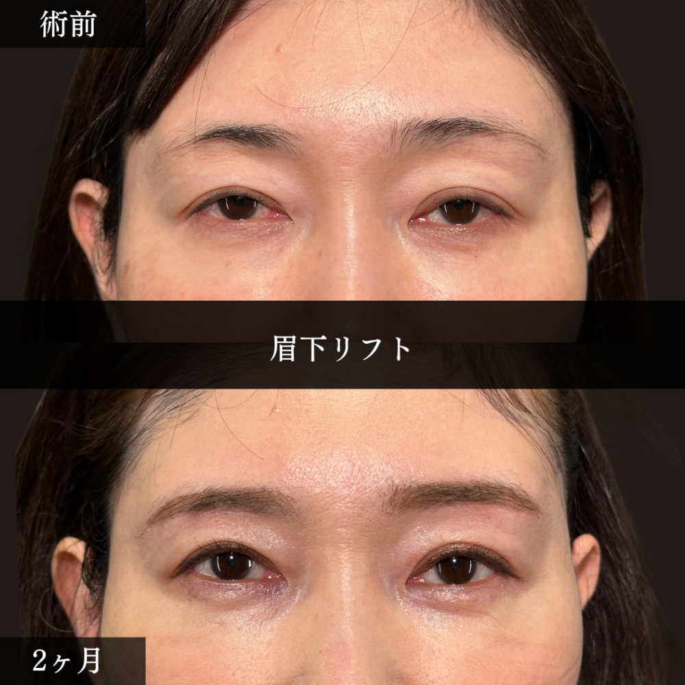 眉下リフト 眉下リフト