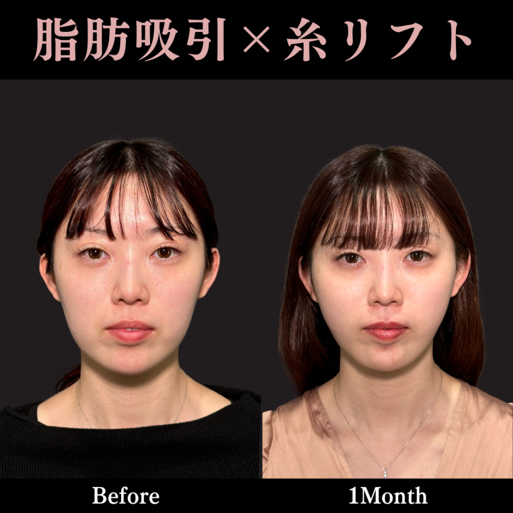 脂肪吸引+糸リフト