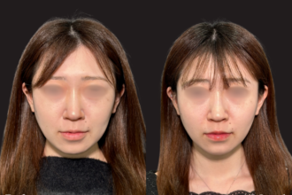 PRISMリフト ＋ ヒアルロン酸注射（顎）