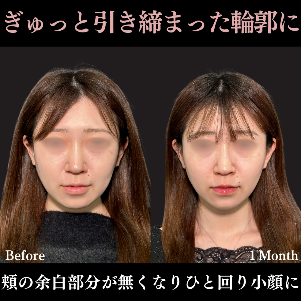 PRISMリフト ＋ ヒアルロン酸注射（顎）