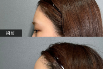 顔の脂肪注入（額）