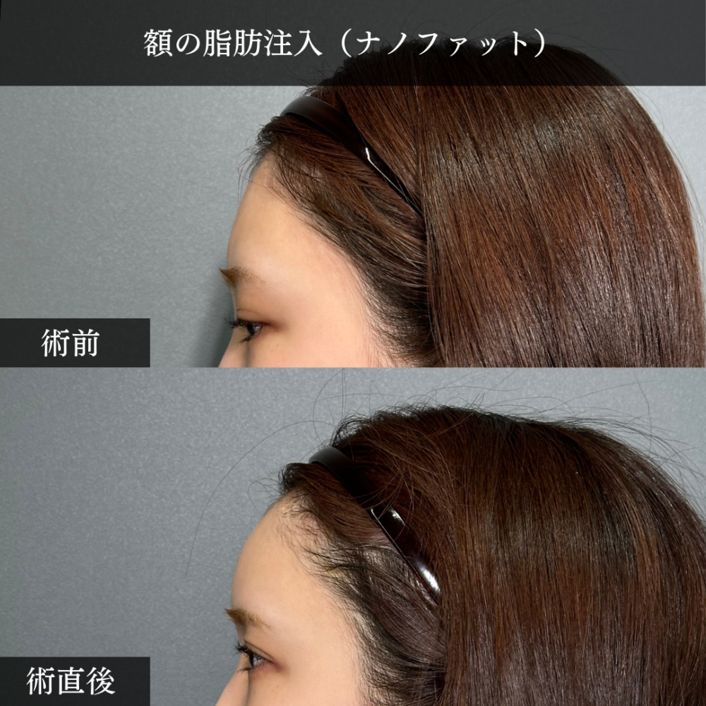 顔の脂肪注入（額）