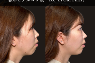 ヒアルロン酸注射