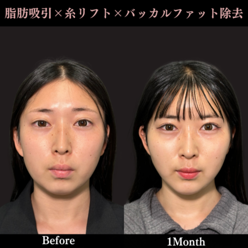 顔の脂肪吸引プレミアム（頬＋あご下）＋バッカルファット除去＋PRISMリフト