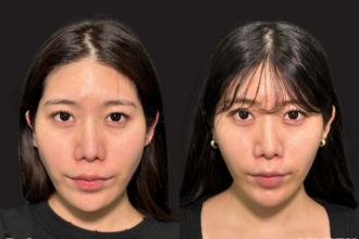 糸リフト（アルテミスリフト10本）＋エラのボトックス注射