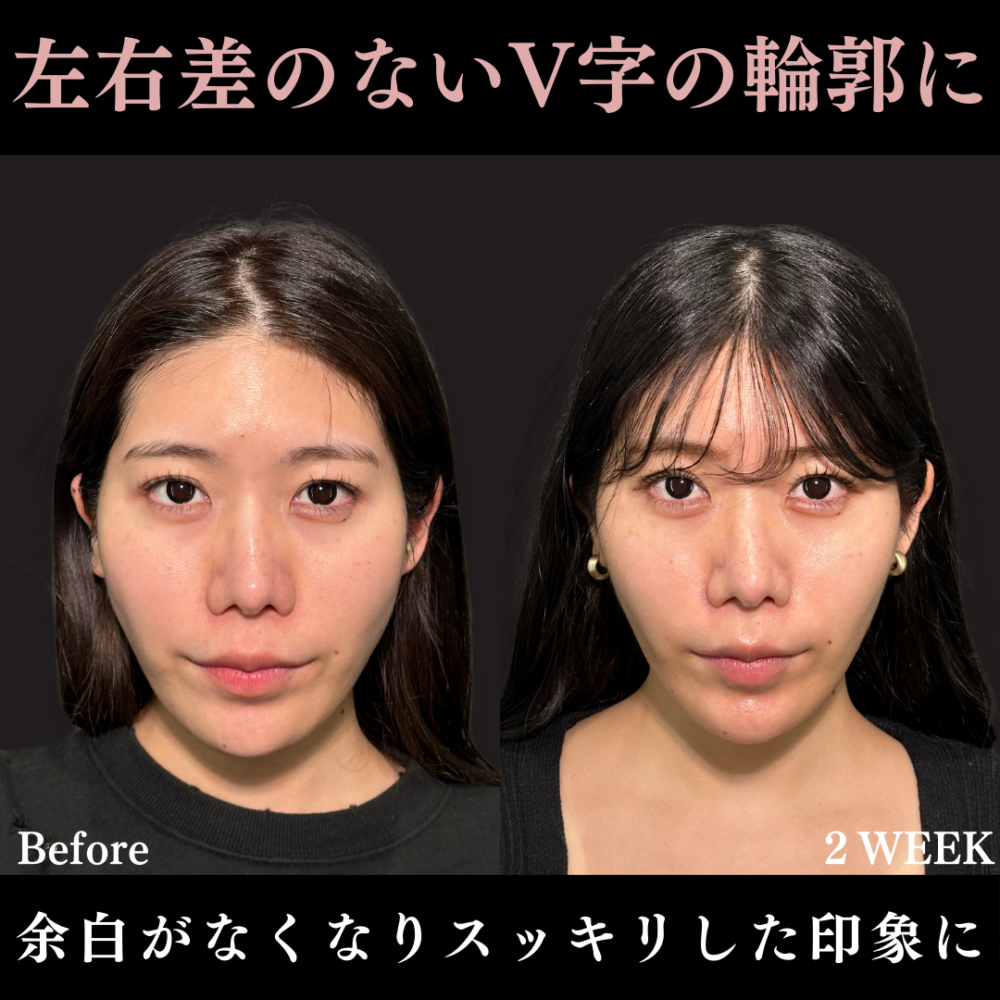 糸リフト（アルテミスリフト10本）＋エラのボトックス注射