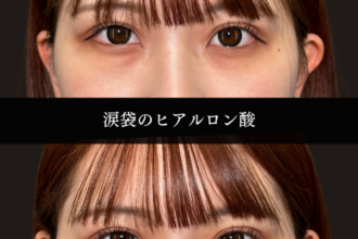 ヒアルロン酸注射（涙袋）