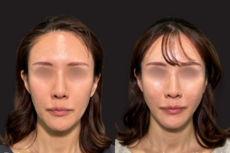 ウルトラソフト＋ ヒアルロン酸注射（頬）