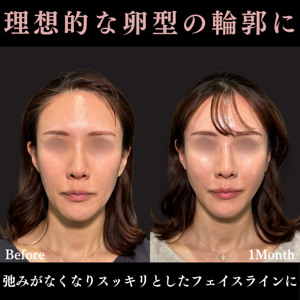 ウルトラソフト＋ ヒアルロン酸注射（頬）