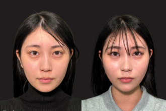 PRISMリフト ＋ ボトックス注射（エラ） ＋ ヒアルロン酸注射（顎）