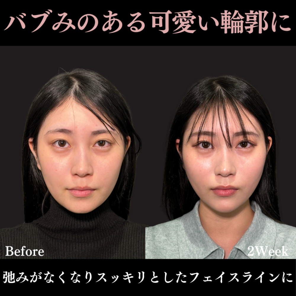 PRISMリフト ＋ ボトックス注射（エラ） ＋ ヒアルロン酸注射（顎）