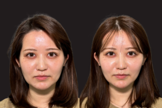 PRISM小顔美肌リフト（Style.V）