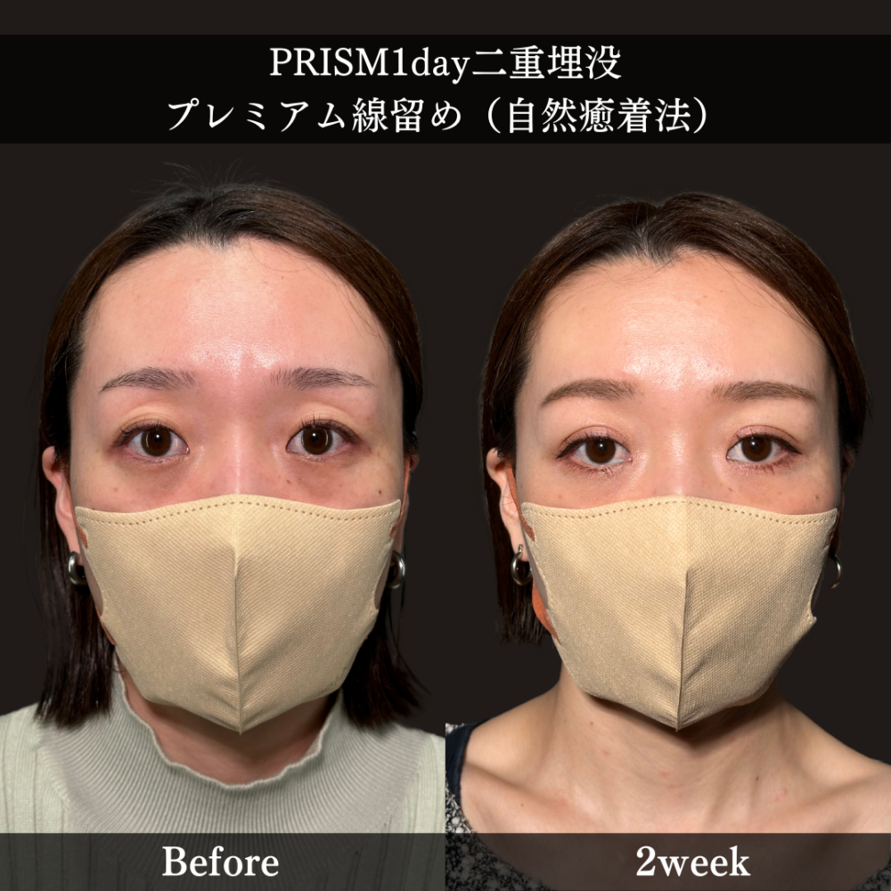PRISM 1day二重埋没