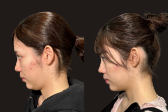 脂肪吸引クイック（あご下）