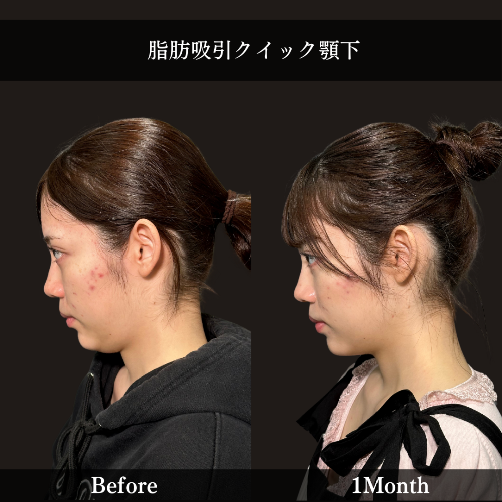 脂肪吸引クイック（あご下）