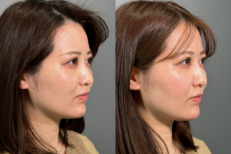 PRISMノーズスレッド