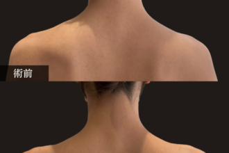 ボトックス注射（肩）