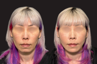 ウルトラソフト＋ヒアルロン酸（顎・頬・ほうれい線）