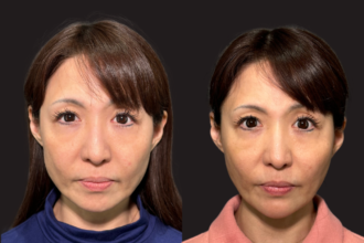 PRISMリフト＋あご先リフト＋ボトックス注射（エラ）