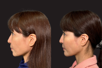 PRISMリフト＋あご先リフト＋ボトックス注射（エラ）