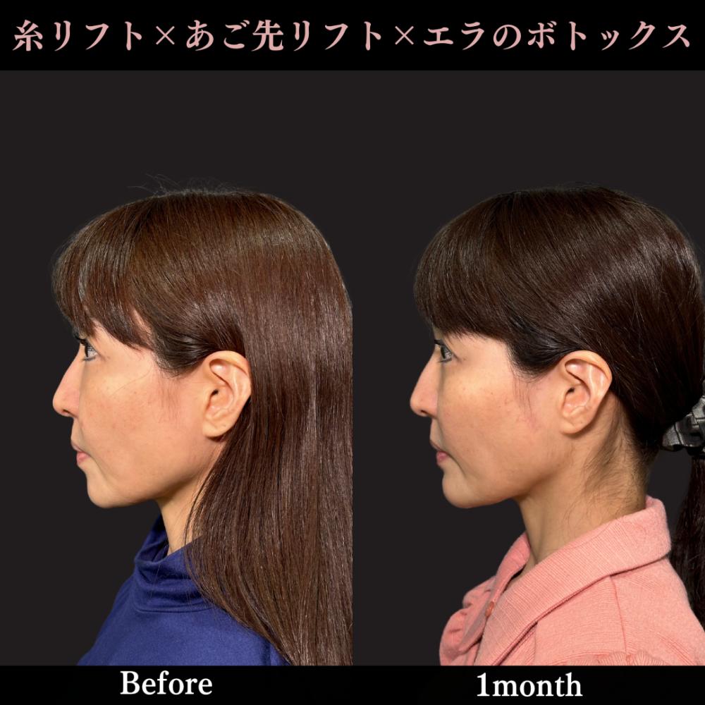 PRISMリフト＋あご先リフト＋ボトックス注射（エラ）