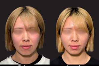 脂肪吸引プレミアム（頬＋あご下）＋PRISMリフト