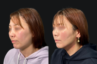 脂肪吸引プレミアム（翌日）