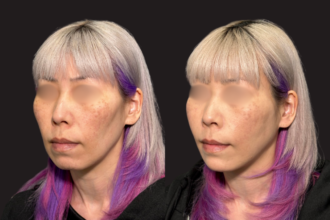 ウルトラソフト＋ヒアルロン酸（顎・頬・ほうれい線）