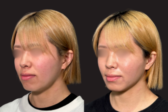 脂肪吸引プレミアム（頬＋あご下）＋PRISMリフト