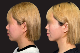 脂肪吸引プレミアム（頬＋あご下）＋PRISMリフト