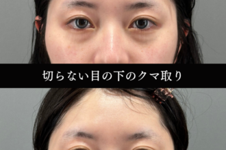 切らない目の下のクマ取り