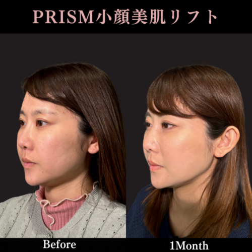 PRISMリフト（ソフト4本＋V2本）