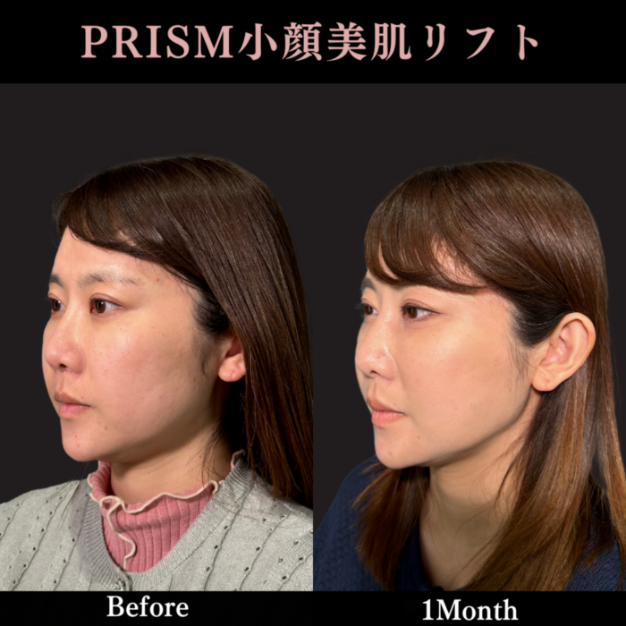 PRISMリフト